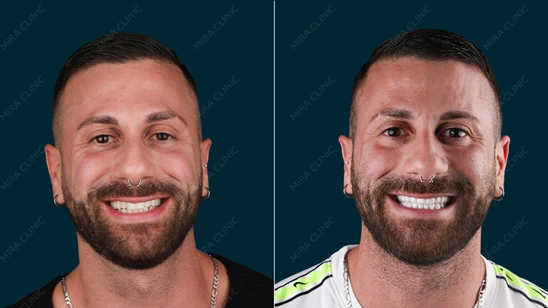 Hollywood smile Antonio Before and after 